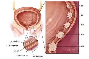 best doctor for bladder cancer treatment in india, best hospital for bladder cancer treatment in india, cost of bladder cancer treatment in india, dr Vinay Gaikwad best Cancer Surgeon in india